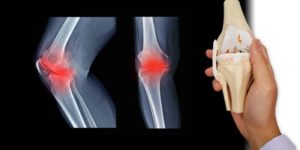 Tratamiento Artrosis Rodilla